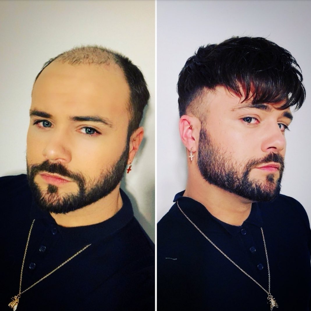 Mens glue discount on hair piece